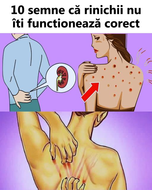 Dacă rinichii tăi nu funcționează corect, corpul îți transmite aceste 10 semne – vezi în comentarii