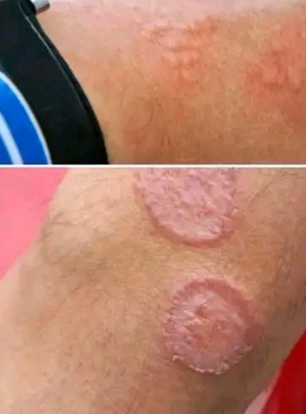 Urme misterioase rotunde pe piele – Ce înseamnă cu adevărat?