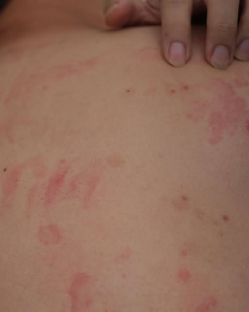 Medicii atrag atenția! Primul simptom este mâncărimea…