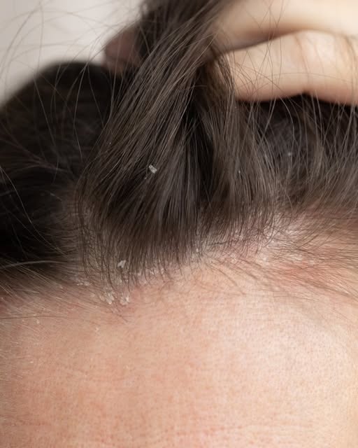 Dacă ai scalpul plin de coji albe, primul lucru pe care trebuie să-l faci este să