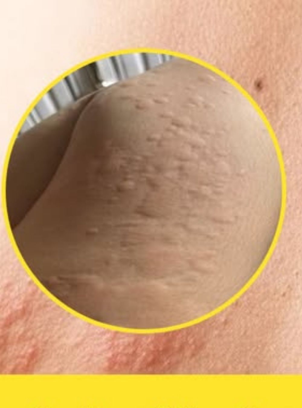 Dacă îți apare asta pe piele, este unul dintre semnele de hi…