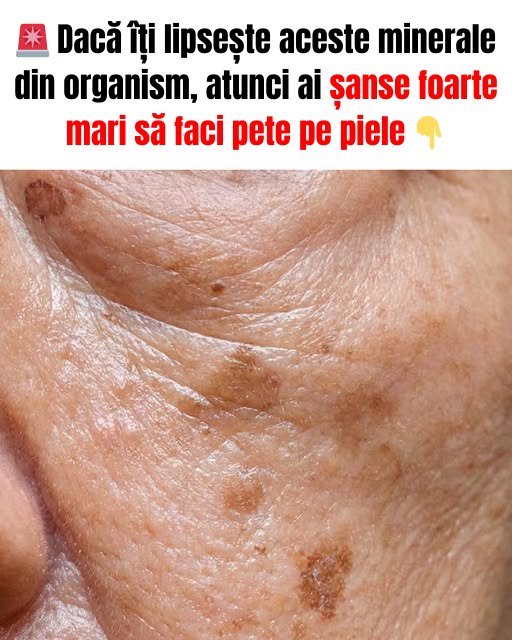 Dacă îți lipsește aceste minerale din organism, atunci ai șanse foarte mari să faci pete pe piele