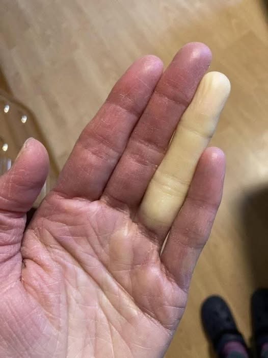 Cum se manifestă boala Raynaud: simptomele care o diferențiază de alte afecțiuni