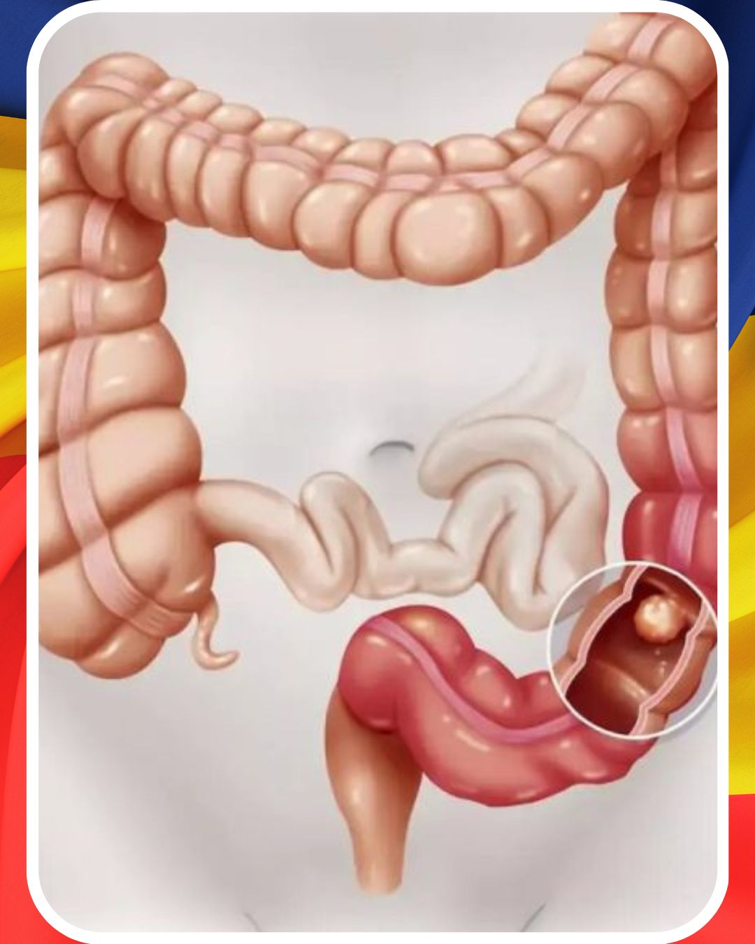Mărul poate fi un aliat blând pentru colonul iritat: susține digestia, ajută la prevenirea constipației, reduce balonarea și contribuie la un tranzit intestinal mai regulat